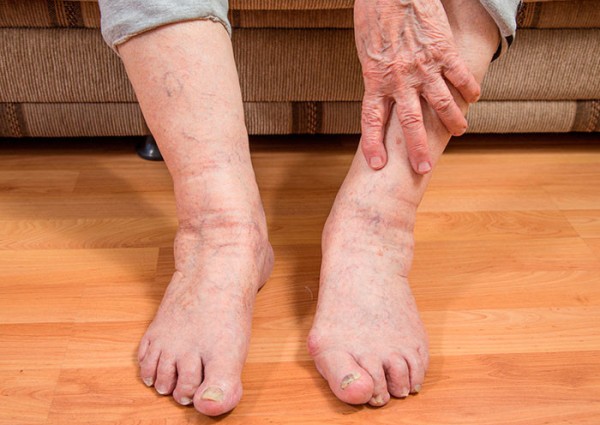 отеки ног у пожилых 