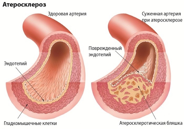 Атеросклероз нижних конечностей 