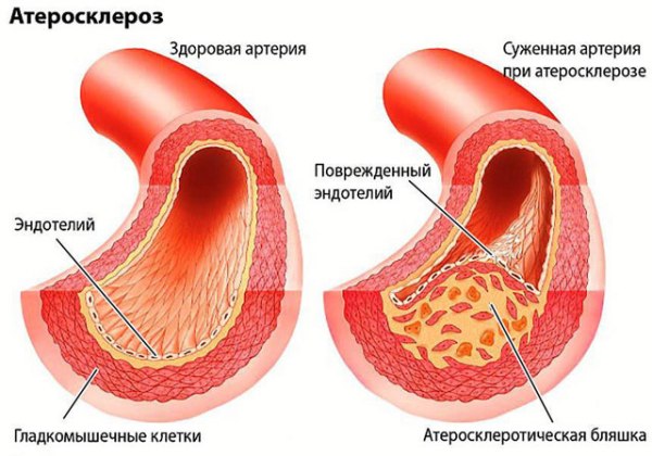 атеросклероз брахиоцефальных артерий
