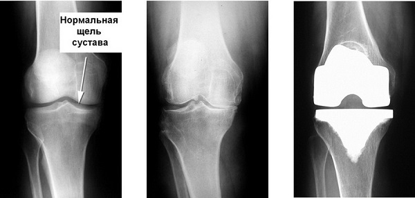 Операция по замене коленного сустава при варикозе — можно делать или нет